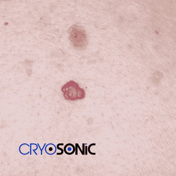 Looking for pain free cherry angioma removal treatment Worksop? Call our team today! Worksop