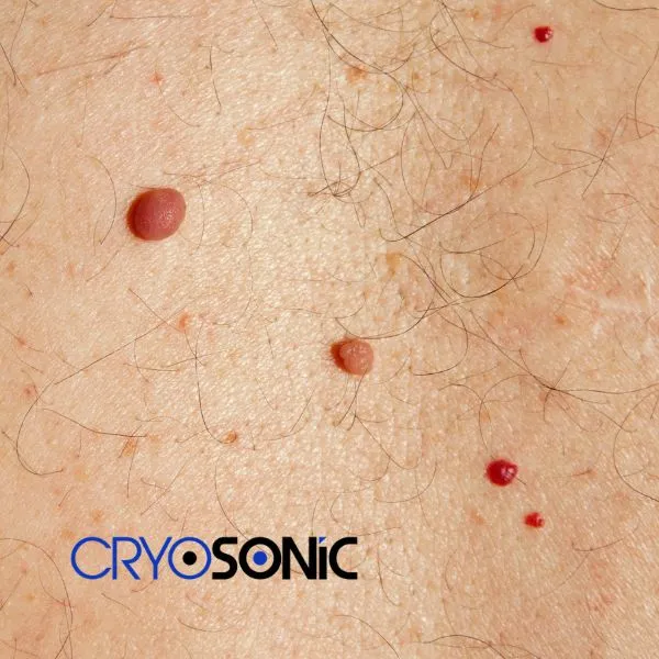get cherry angioma removal treatment today! Worksop