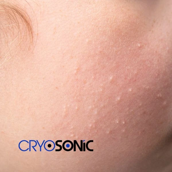 Are you looking for milia removal treatment? Contact our team today Worksop