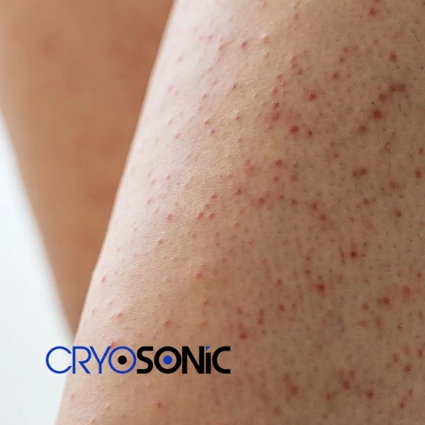 Looking for Seborrhoeic Keratosis removal Worksop treatment? Call our consultants today in Worksop