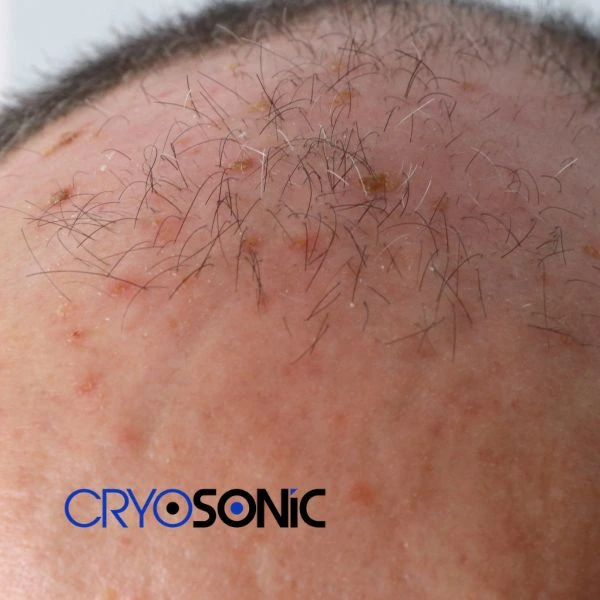 Access Seborrhoeic Keratosis removal from the comfort of your own home! Call us today in Worksop