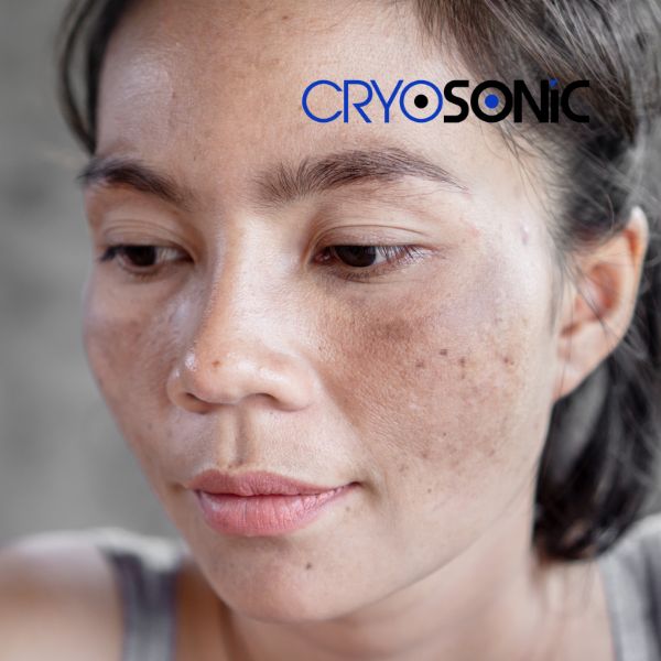 Ready to start age spots removal? Contact our team today in Worksop