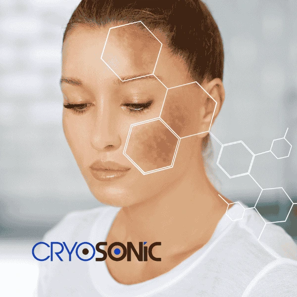 Are you looking for age spot removal treatment? Contact Cryosonic today in Worksop