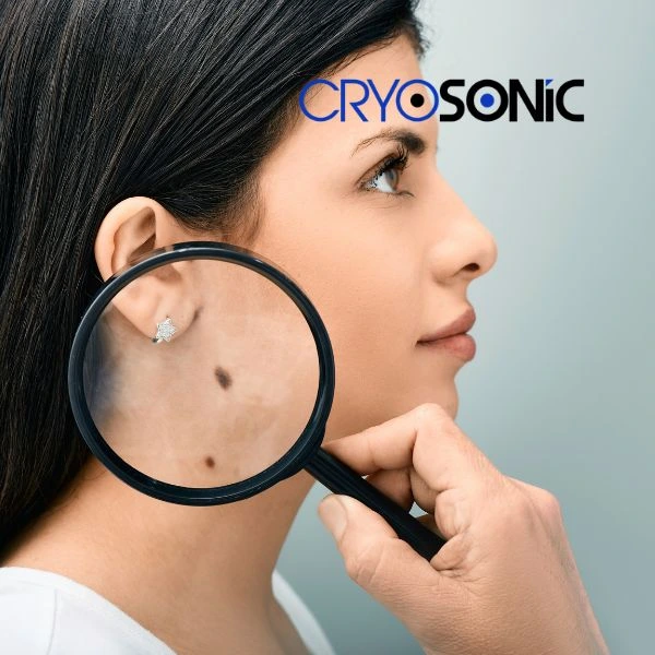 Do you want to learn more about benign moles removal treatment? Call our team today Worksop