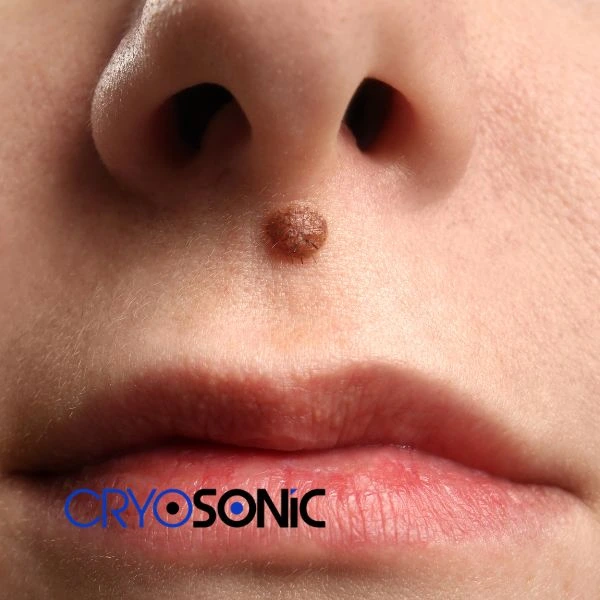 Start your benign moles removal treatment today Worksop