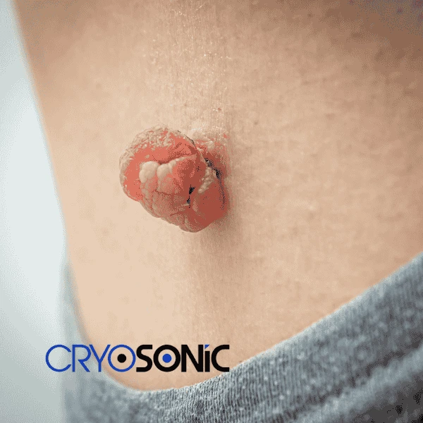 Book your skin tags removal Worksop from comfort of your own home! Worksop