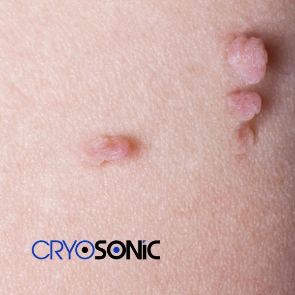 Are you looking for fast effect skin tag removal Worksop? Book in NOW! Worksop