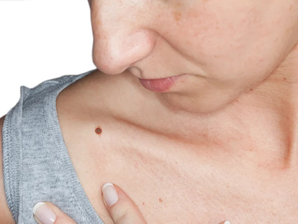 How Does CryoPen Sun Damage Treatment Worksop Work? Worksop