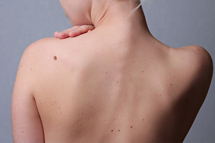 The Skin&rsquo;s Healing Journey After CryoPen Sun Damage Treatment Worksop