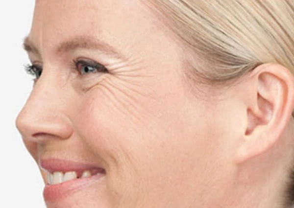 CryoPen Precision vs. Laser: Which Is Better for Sun-Damaged Skin? Worksop