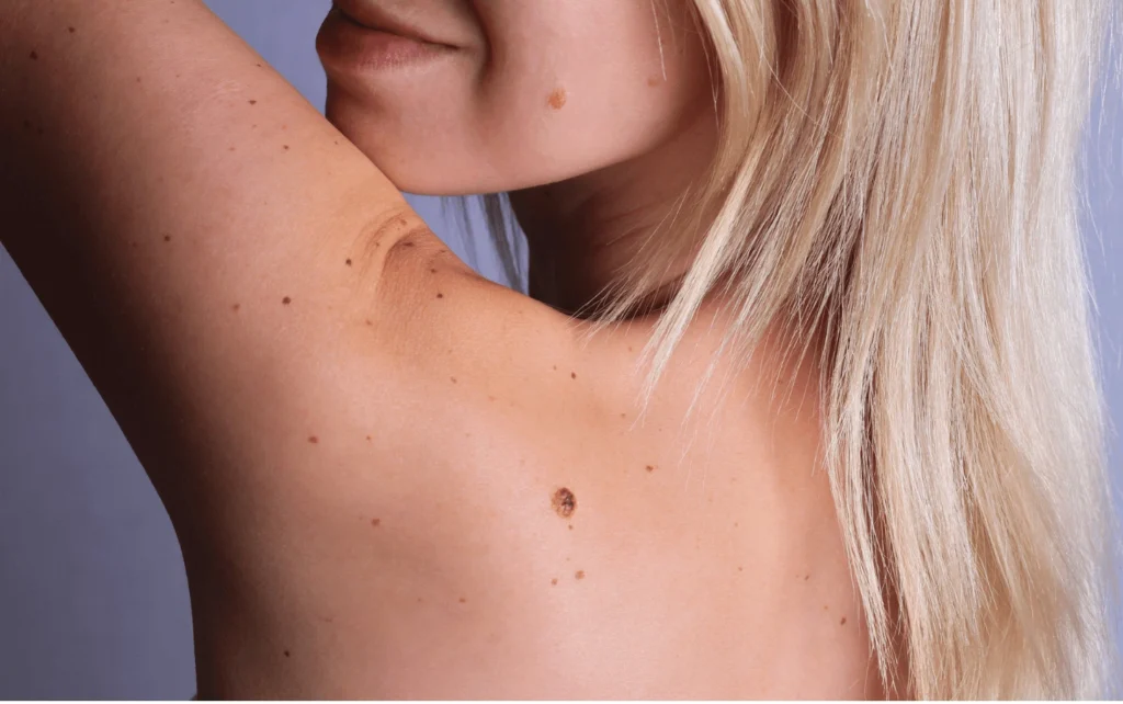 What Are Sun Spots and Pigmentation Worksop? Worksop