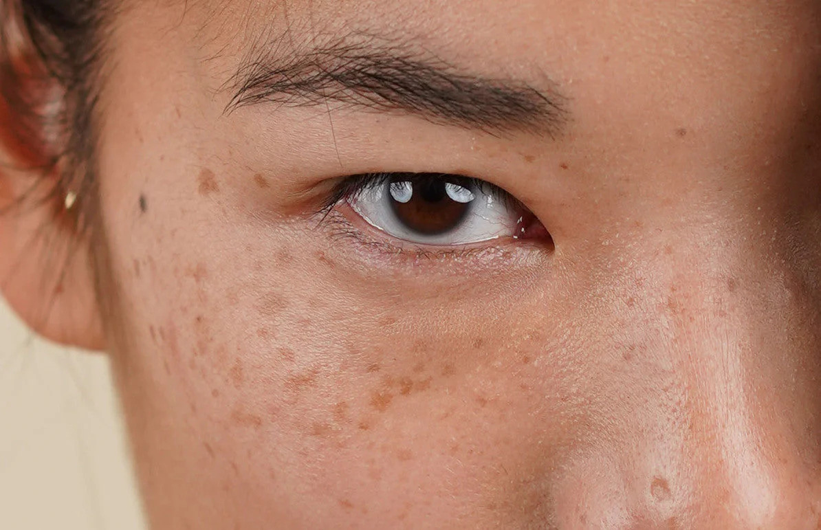 Is There Any Risk of Scarring or Pigmentation Worksop? Worksop