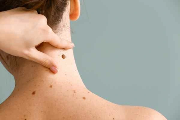 Who Should Avoid CryoPen Treatments? Worksop