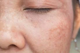 CryoPen Precision vs. Laser: Are Both Treatments Safe? Worksop
