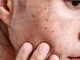 Why CryoPen Works Best for Isolated Sun Spots and Pigmentation Worksop